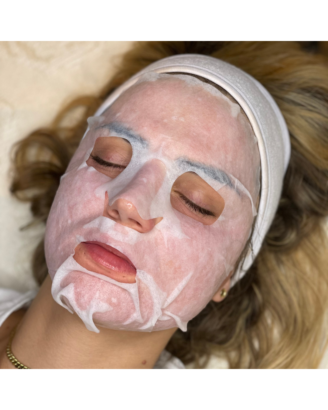 Microneedling